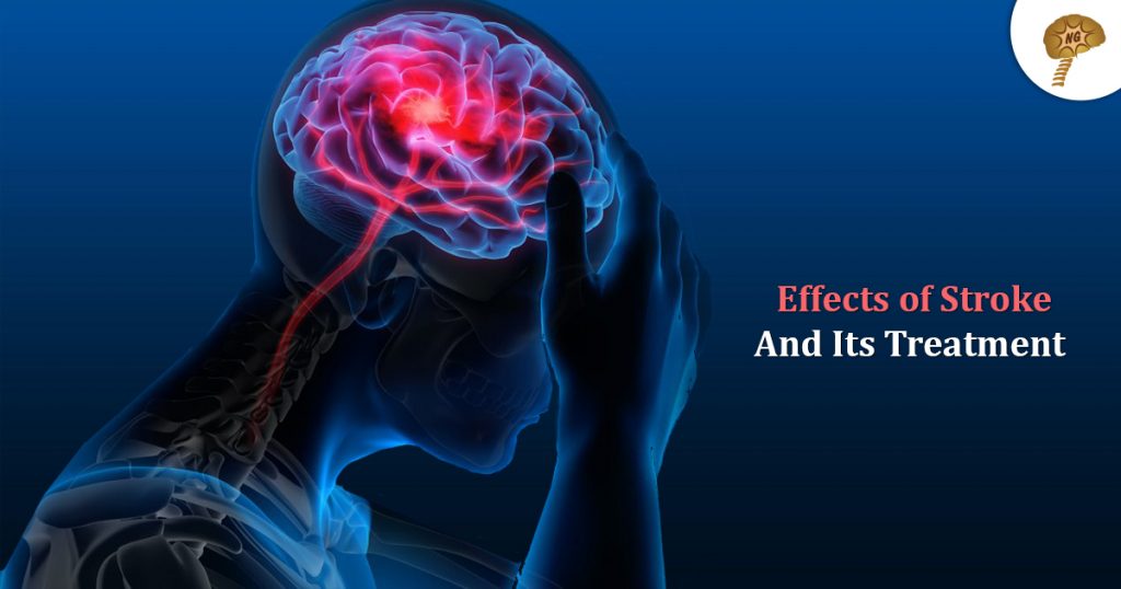 Effects of Stroke and its Treatment | NeuroGen BSI